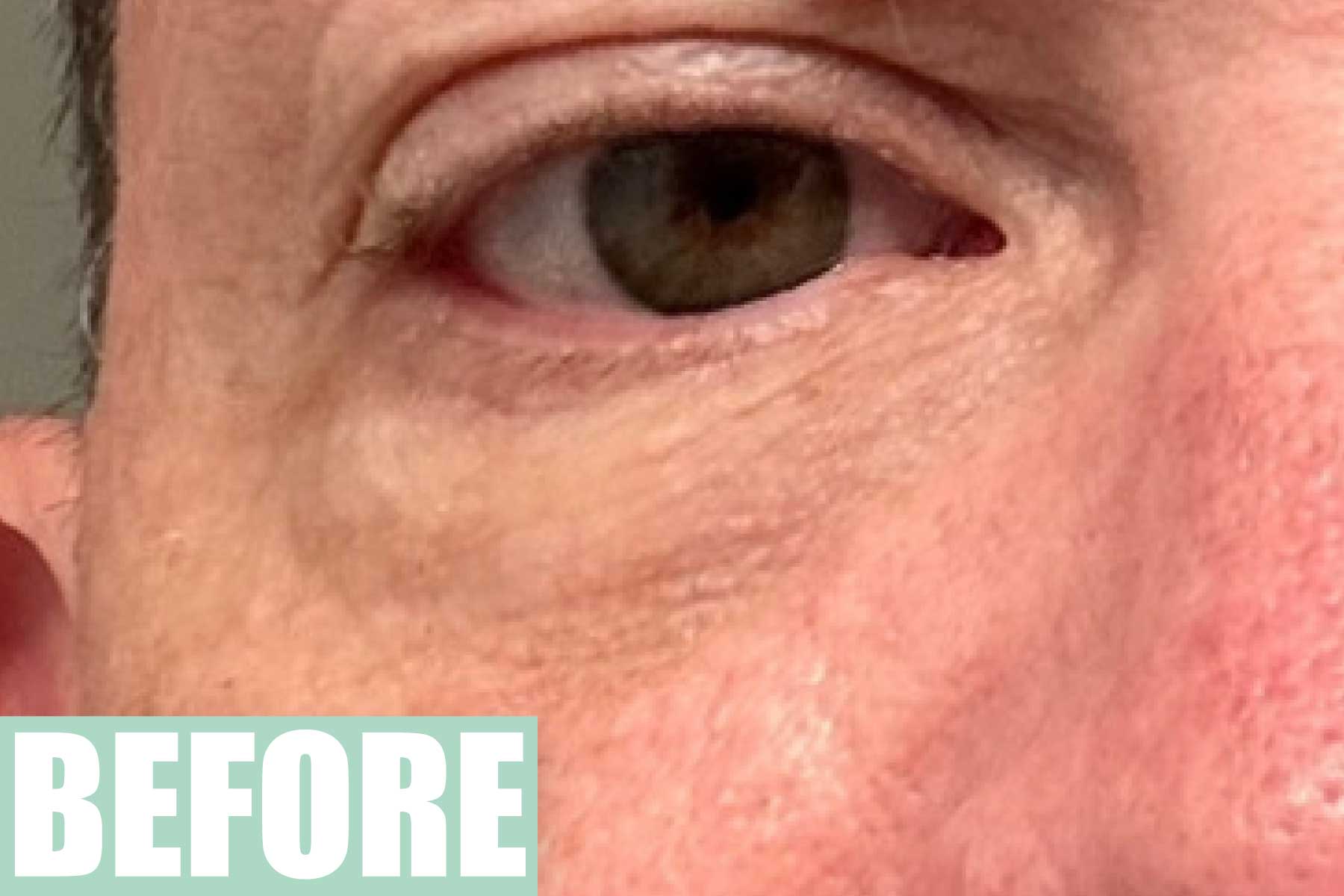 Before photo showing under-eye texture